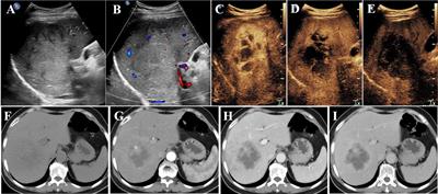 Primary hepatic squamous cell carcinoma: case report and systematic review of the literature